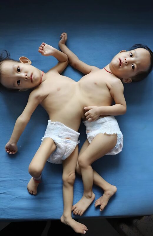 After a complex and risky operation doctors managed to separate these conjoined twin sisters