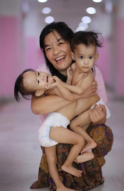 After a complex and risky operation doctors managed to separate these conjoined twin sisters