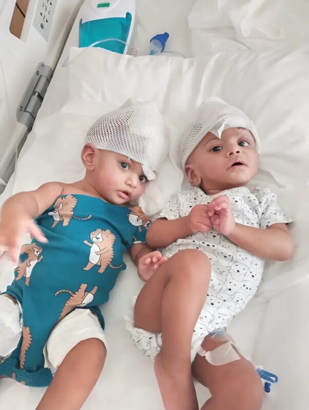 Conjoined twins with fused brains separated after a 14-hour surgery