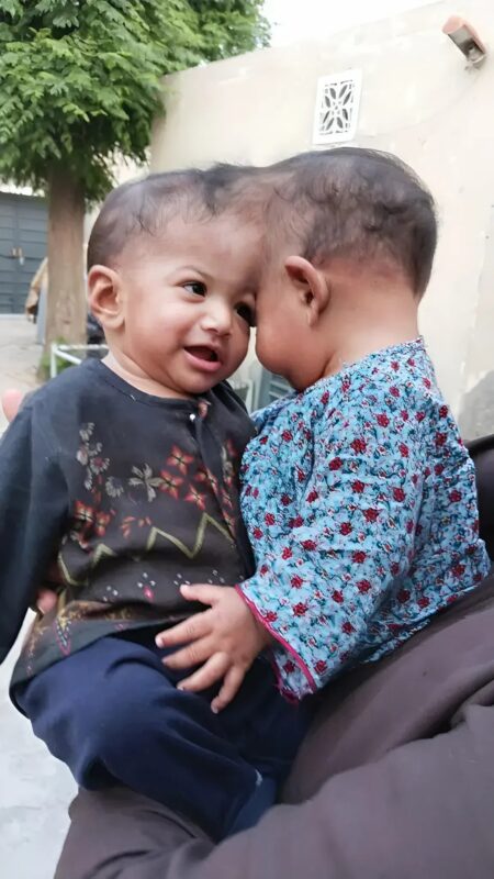 Conjoined twins with fused brains separated after a 14-hour surgery