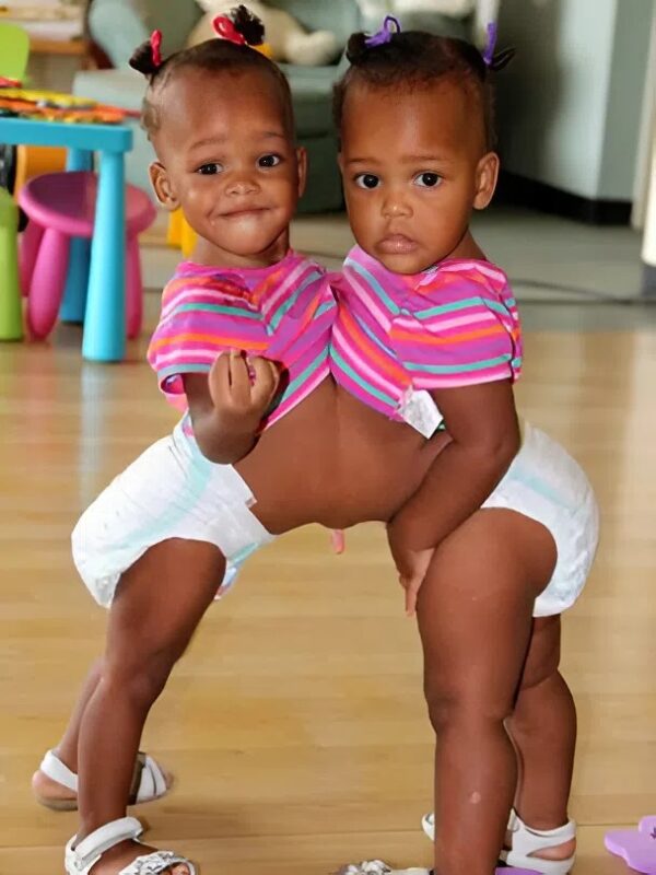 María and Teresa Tapia were inseparable in the literal sense of the word but doctors managed to separate them